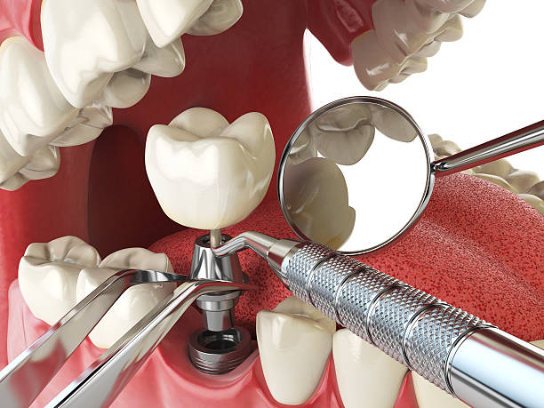 Best Emergency Dental Care for Sports Injuries in Petersburg, WV